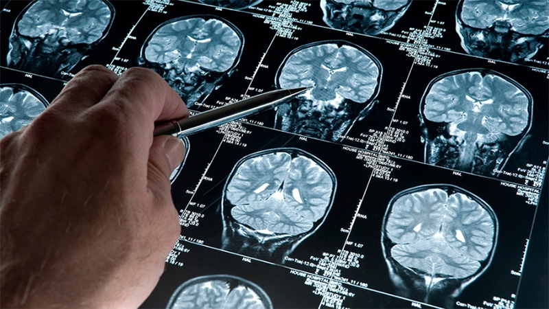 El Alzheimer puede detectarse 20 años antes de la aparición de síntomas